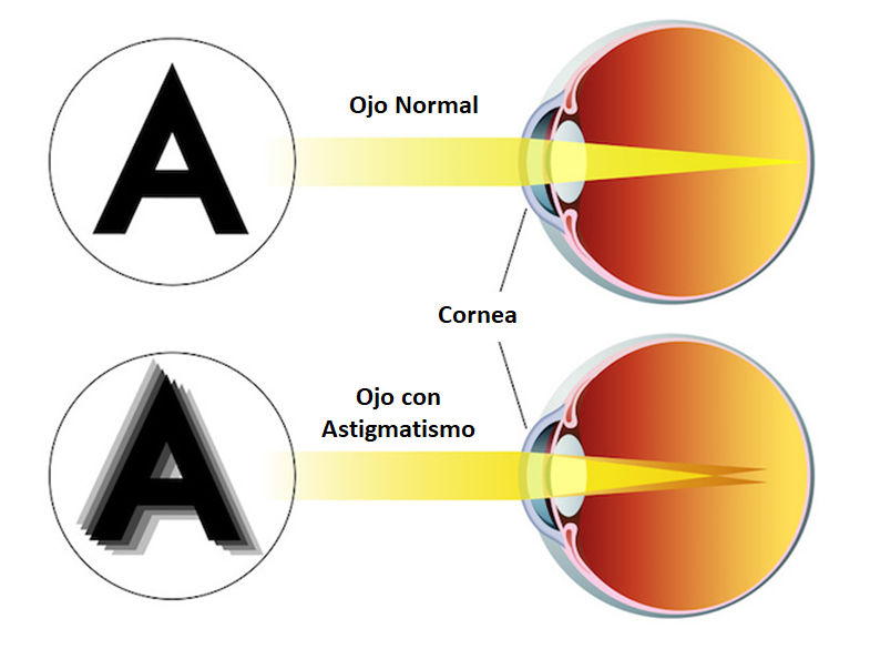 astigmatismo miopia